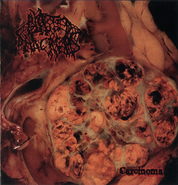 Blasted Pancreas – Carcinoma (2011)